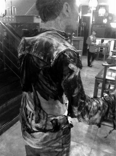 男子吃火锅被重度烧伤 源于服务员加燃料不慎(图)
